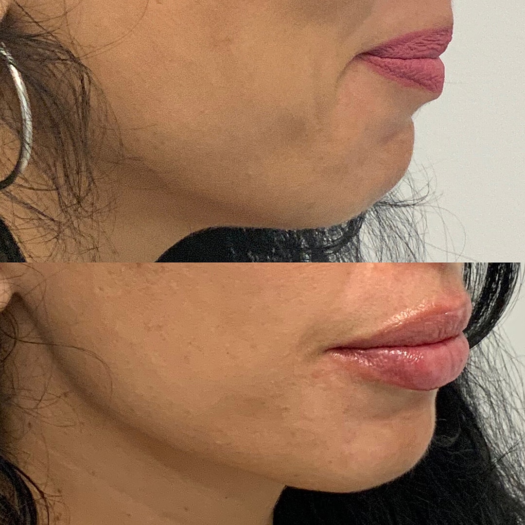 Lip Filler Before & After