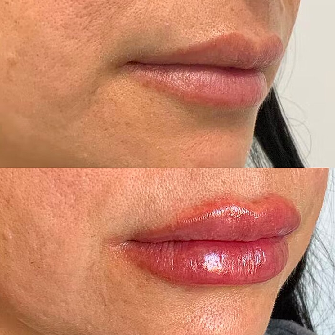 Lip Filler Before & After