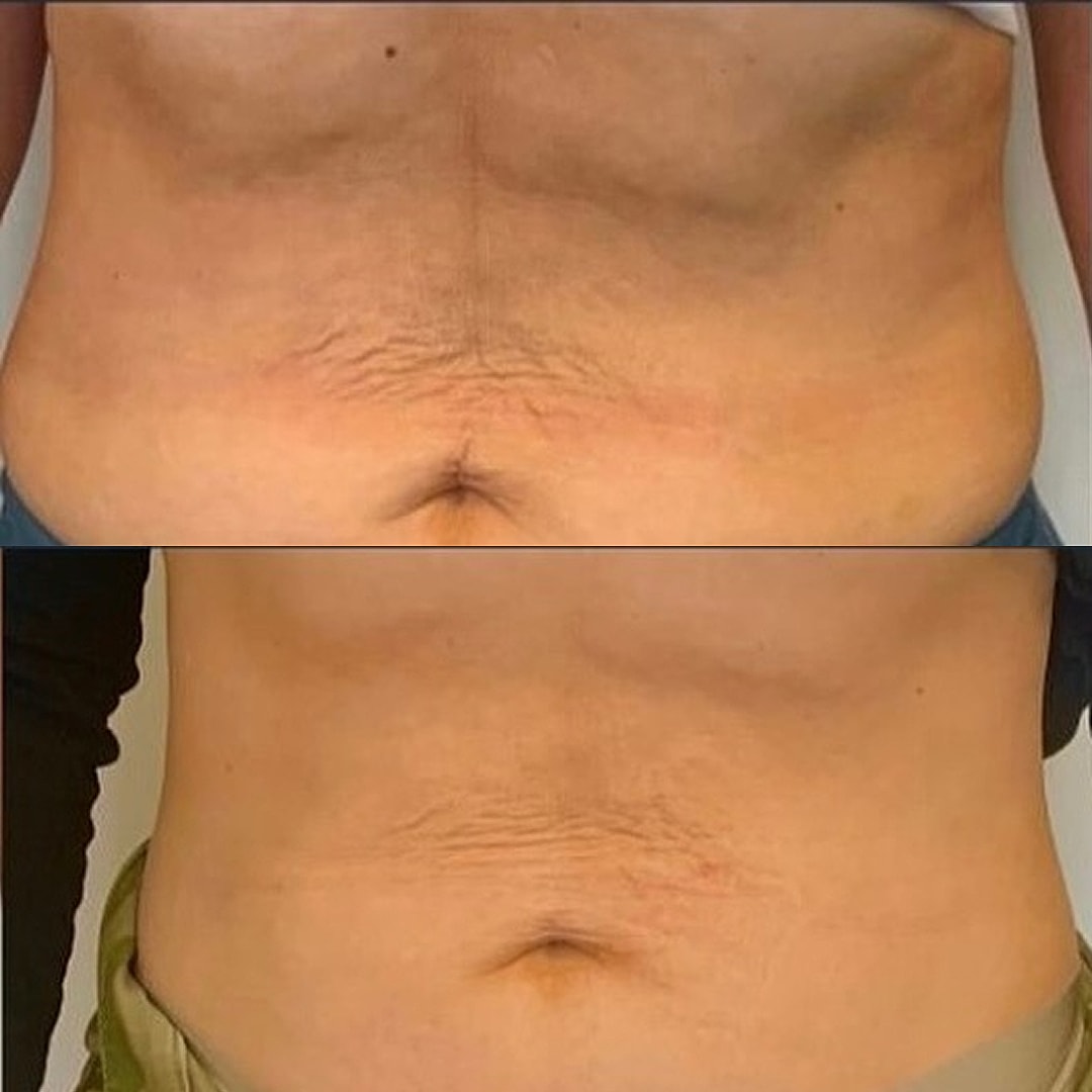 Vivace Microneedling Before & After