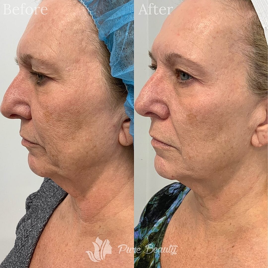 Vivace Microneedling Before & After