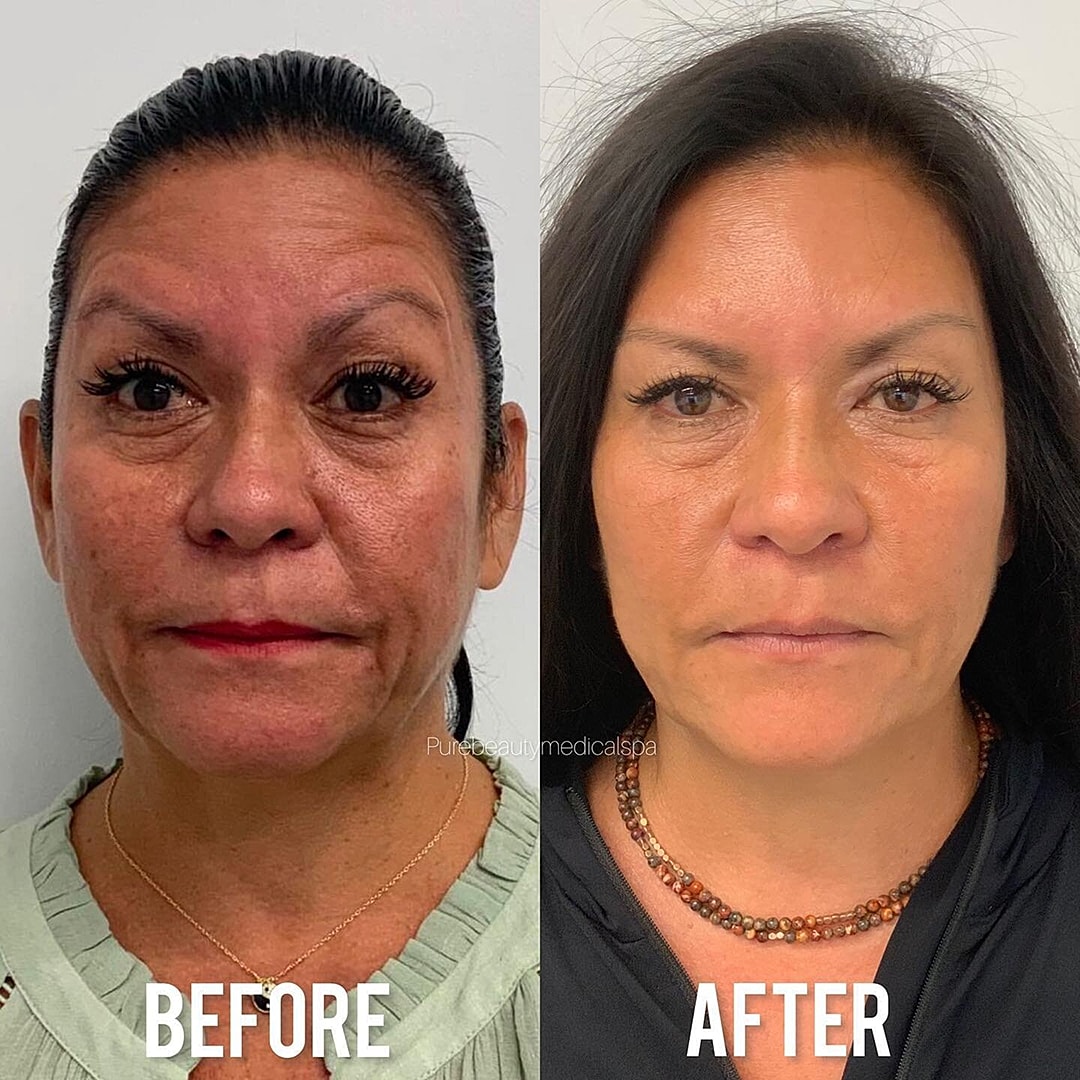Vivace Microneedling Before & After