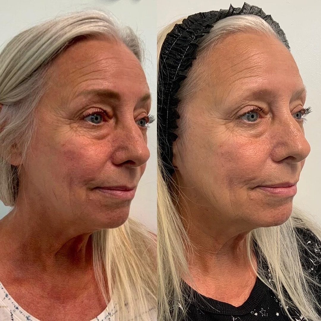 Vivace Microneedling Before & After