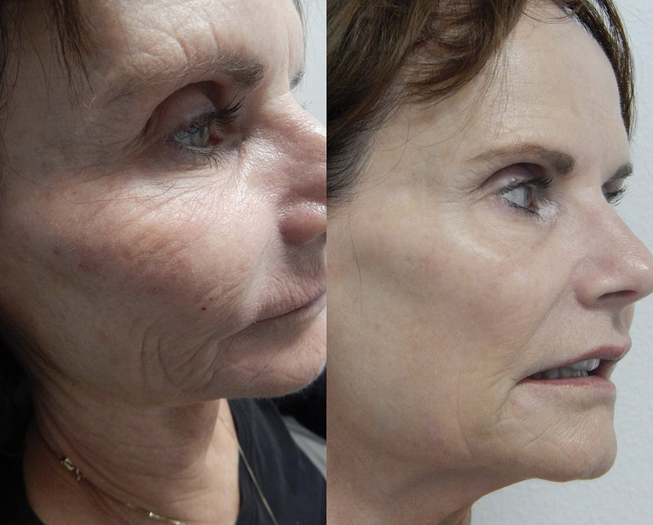 Vivace Microneedling Before & After