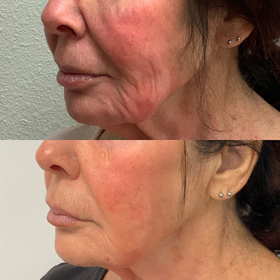 Vivace Microneedling Before & After