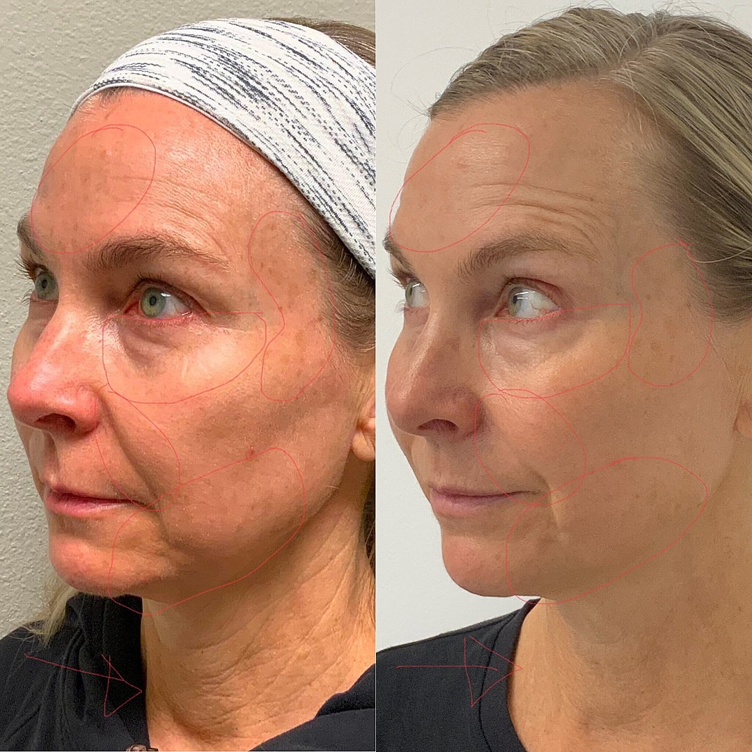 Vivace Microneedling Before & After