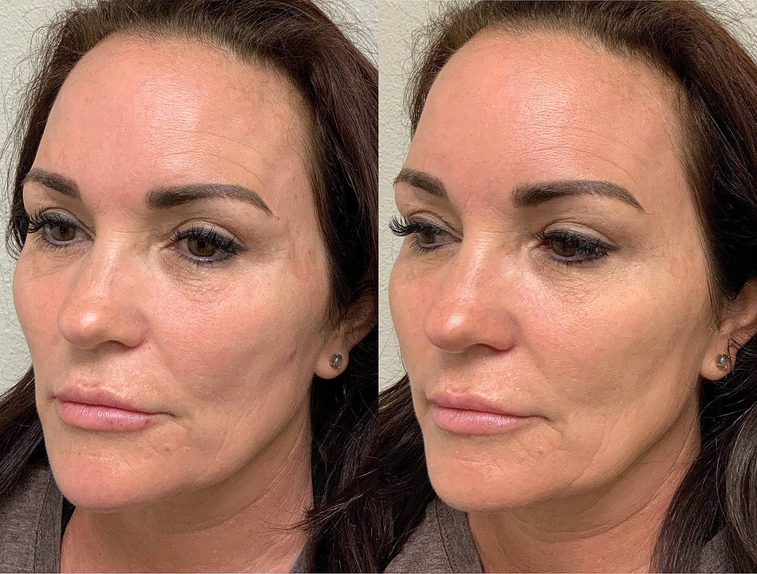 Liquid Facelift Before & After