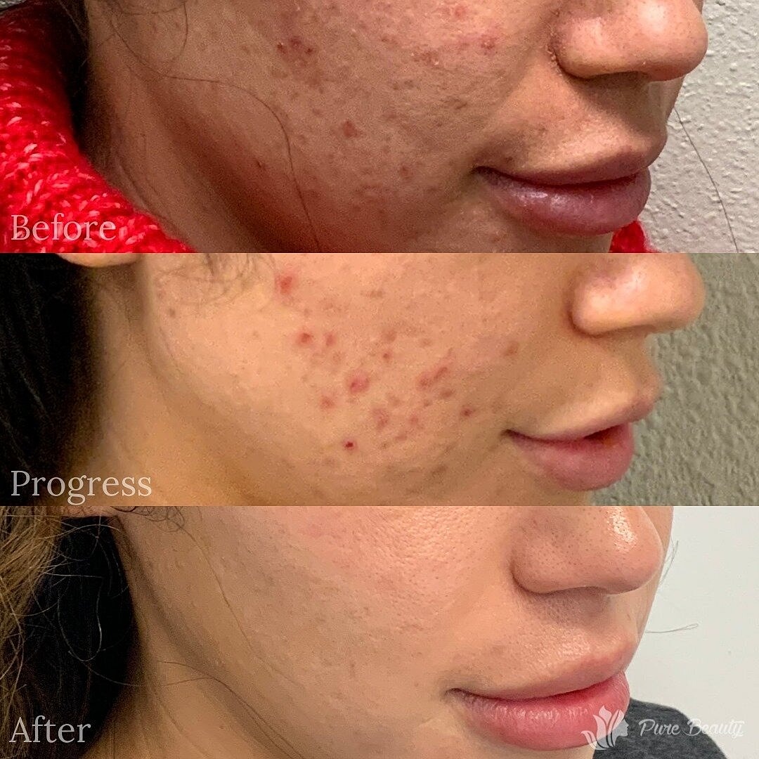 Hydrafacial Before & After