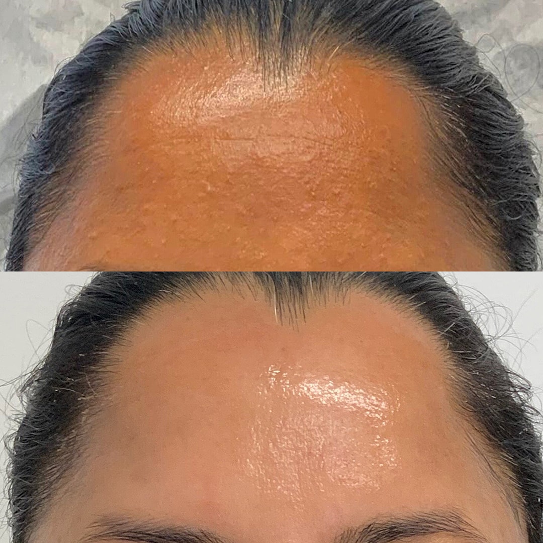 Hydrafacial Before & After
