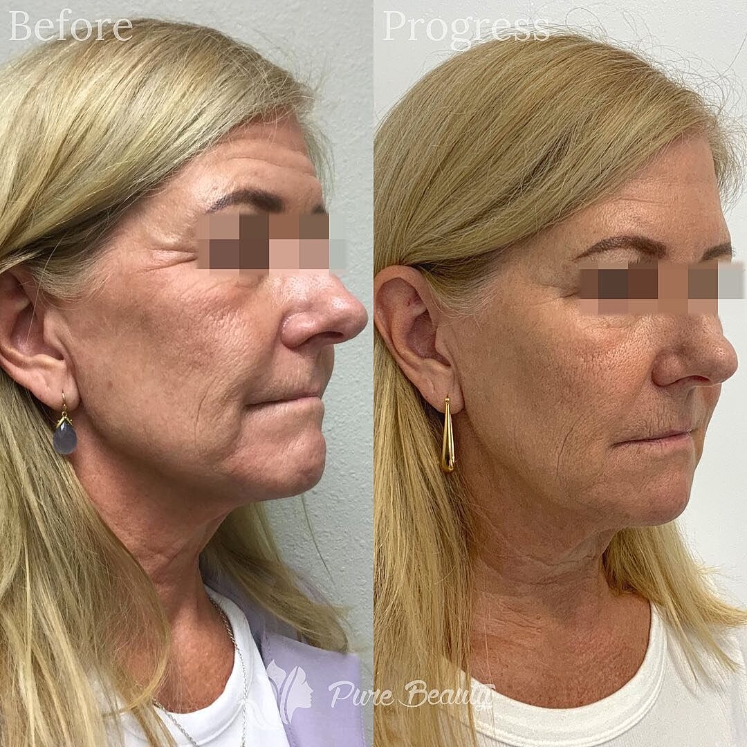 Dermal Fillers Before & After