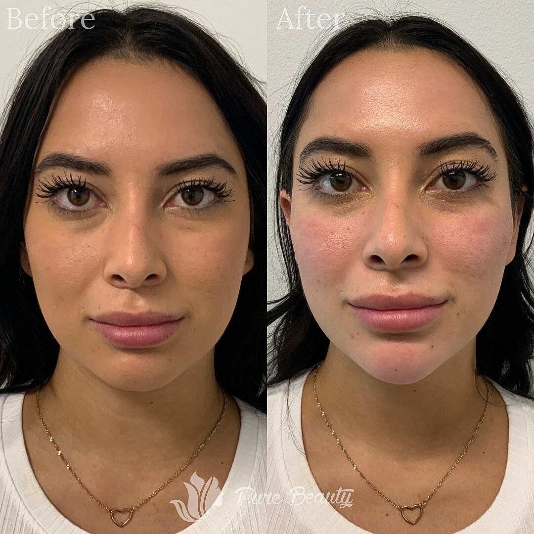 Dermal Fillers Before & After