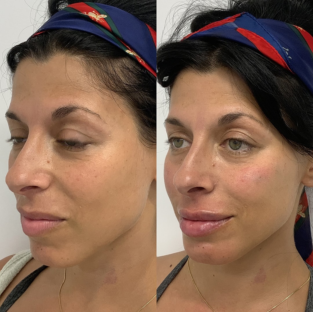 Dermal Fillers Before & After