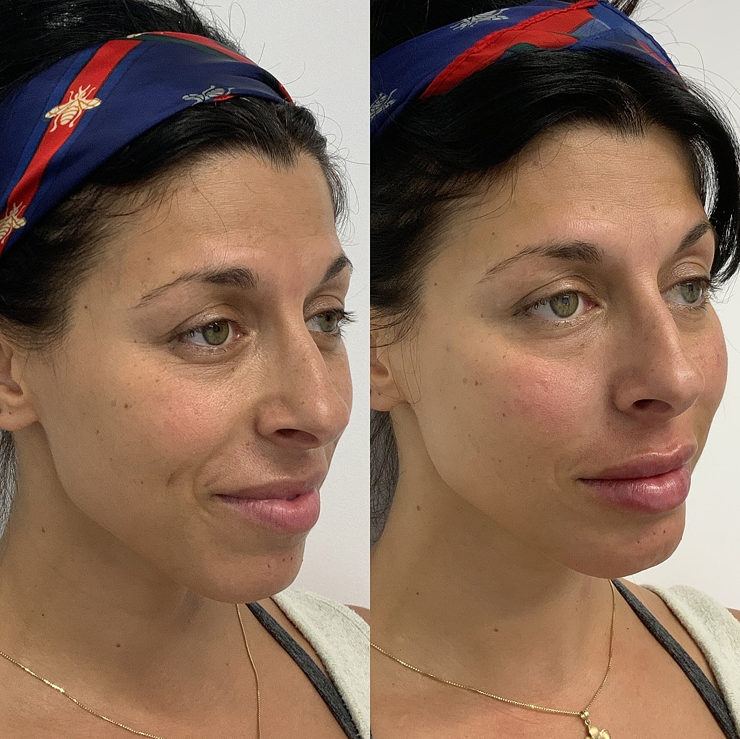 Dermal Fillers Before & After