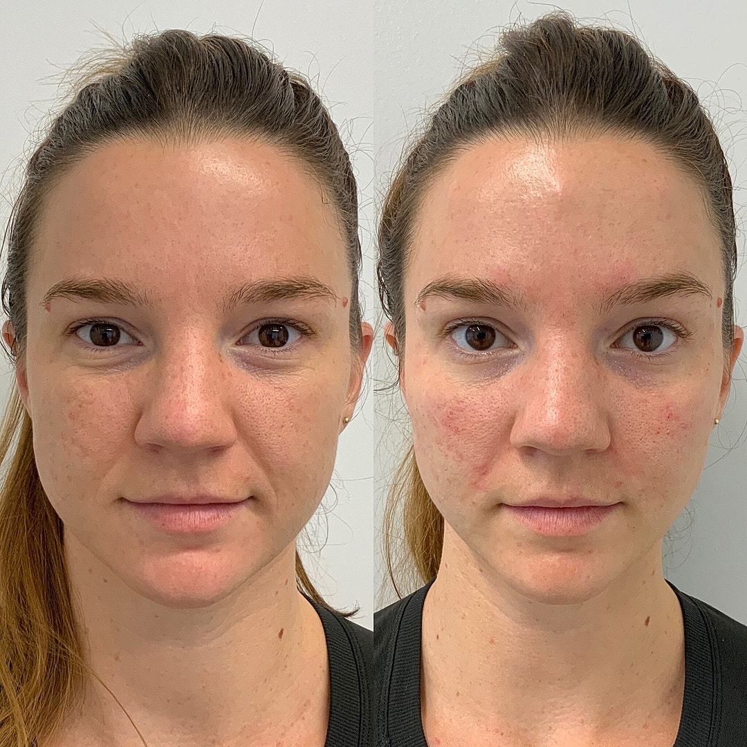 Dermal Fillers Before & After